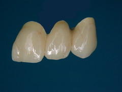 CAD/CAM Zirkonium brug (klik hier voor een groter formaat)